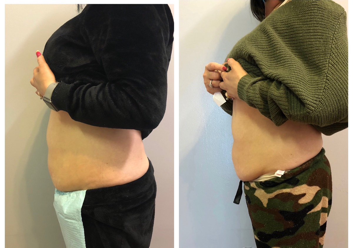 Cavi Lipo (1 area, 3 sessions)
