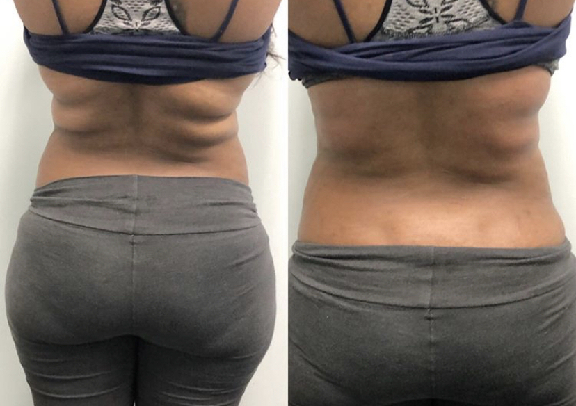 Cavi Lipo (1 area, 6 sessions)