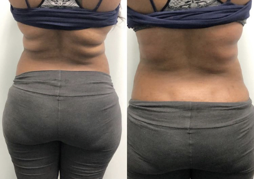 Cavi Lipo (1 area, 1 session)