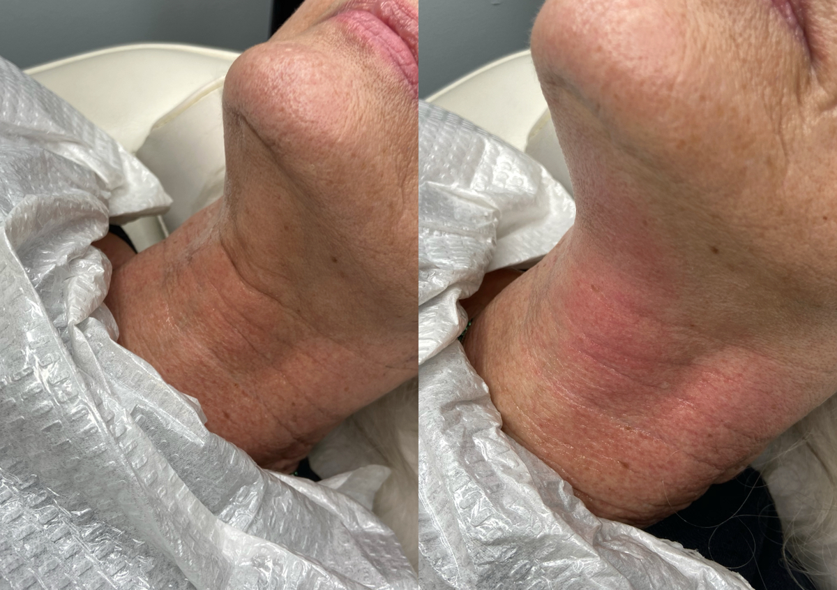 RF Skin Tightening (1 area, 1 session)