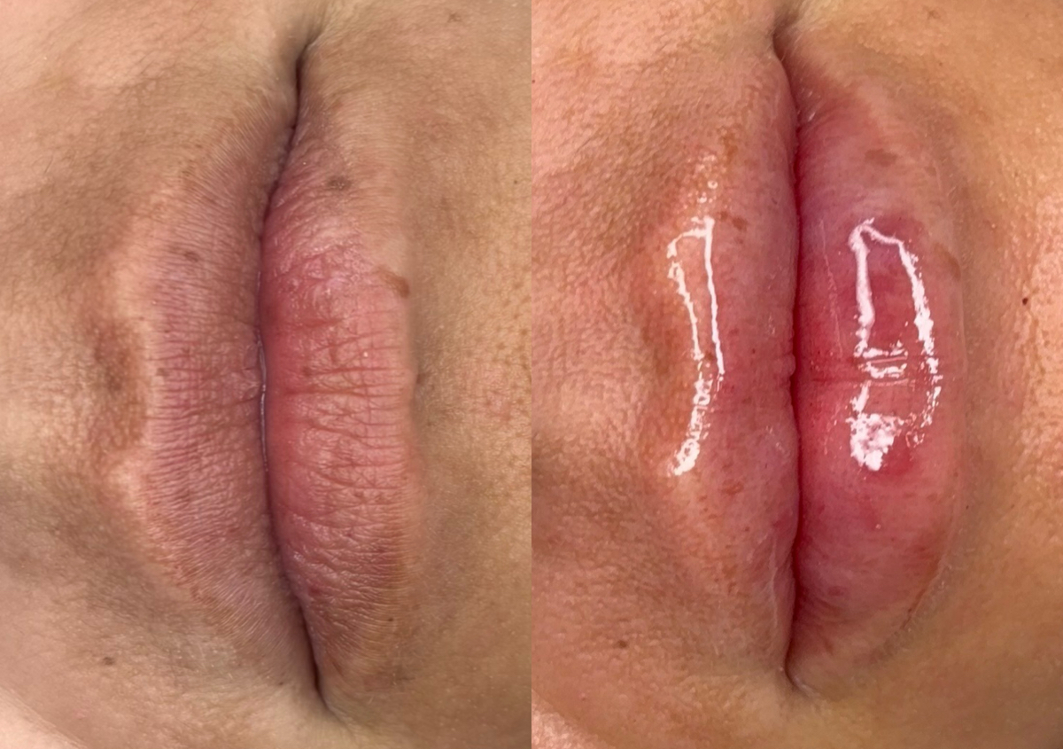 Mini Lip – ( .5mL ) / Consultation + GFE