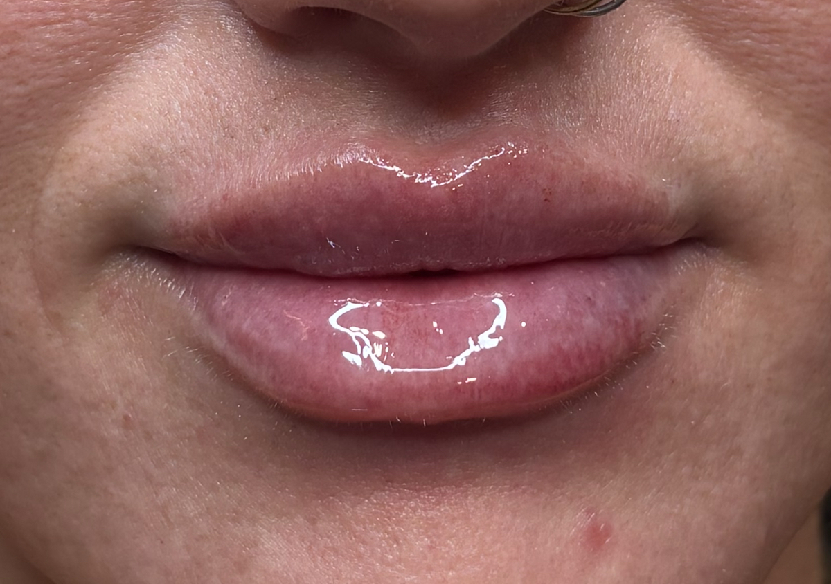 1mL Lip Filler/ Consultation 