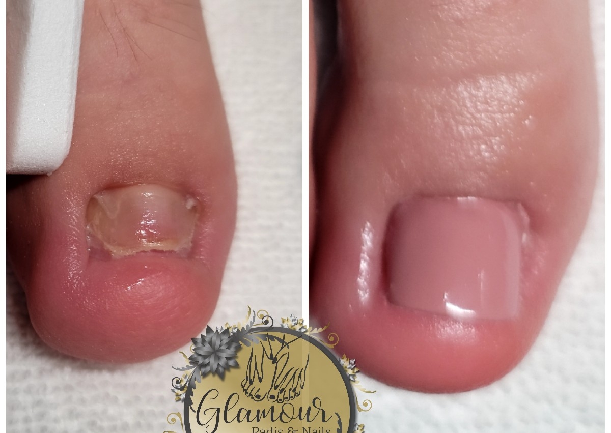 FUNGAL RECONSTRUCTION [RECONSTRUCTION POR HONGO]