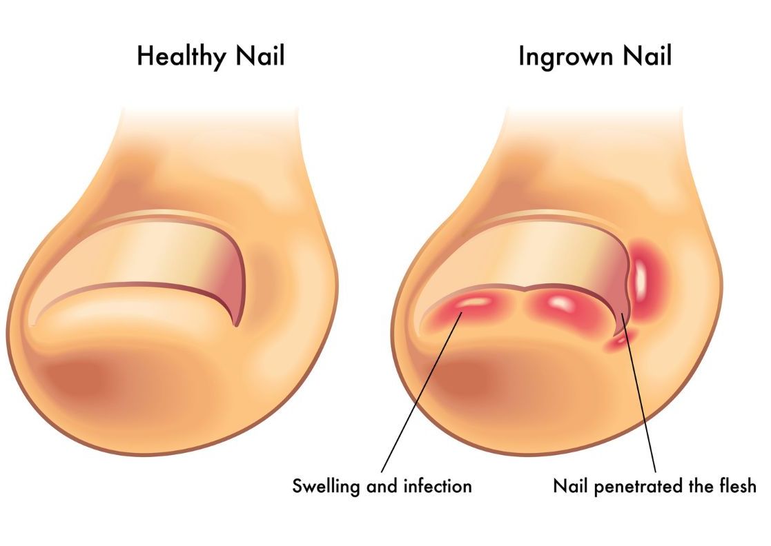 INGROWN TOENAIL(UÑA ENTERRADA)