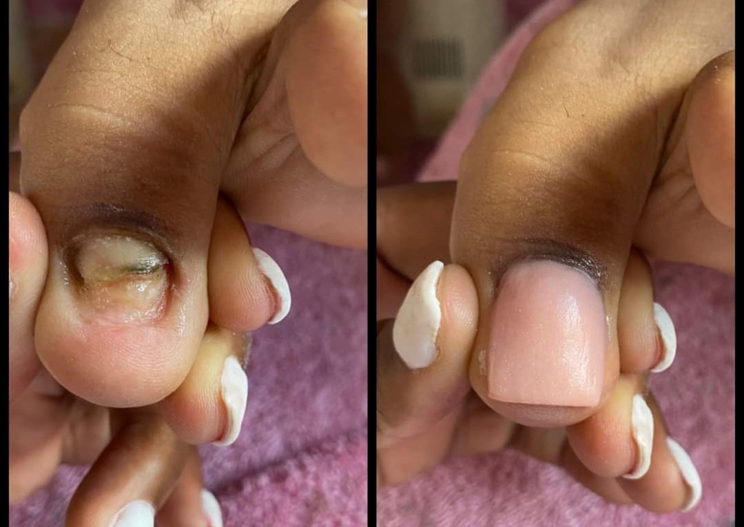 Toe reconstruction 