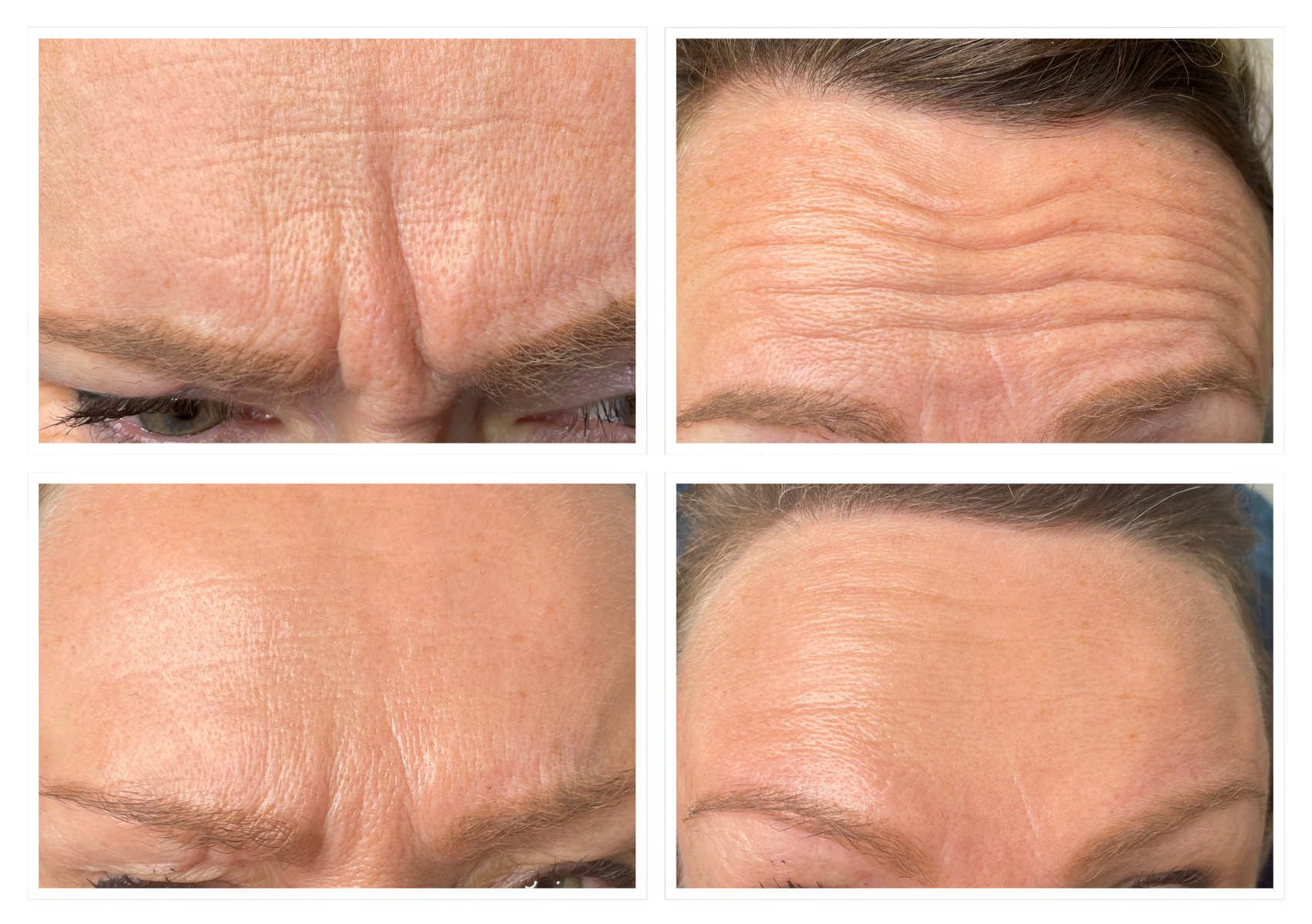 Anti Wrinkle Treatment (2 Areas)