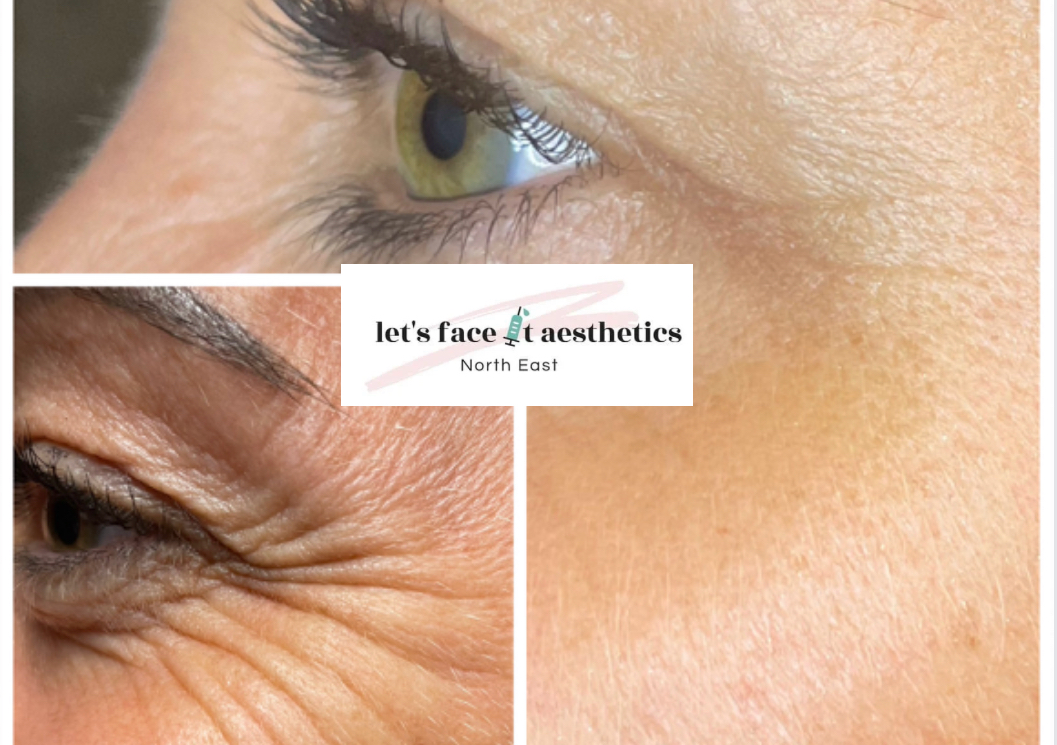 Anti Wrinkle Treatment (Crows Feet)