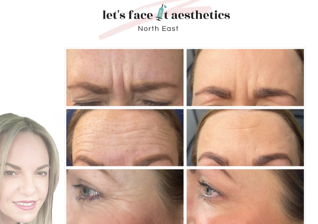 Anti Wrinkle Treatment (3 Areas)