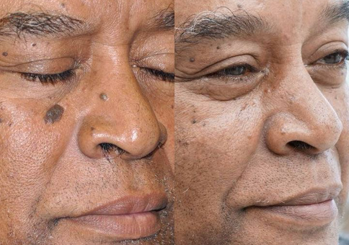 Cauterization of skin tags