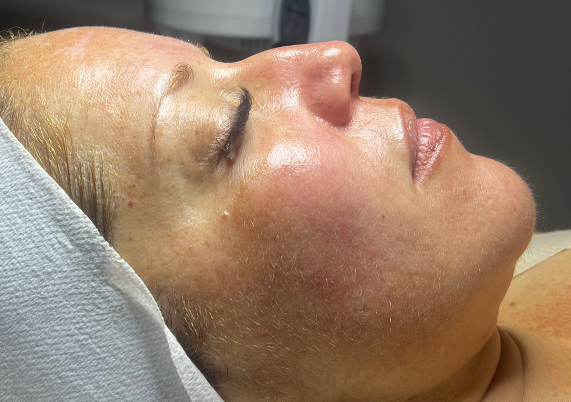 Microneedeling + Salmon DNA 