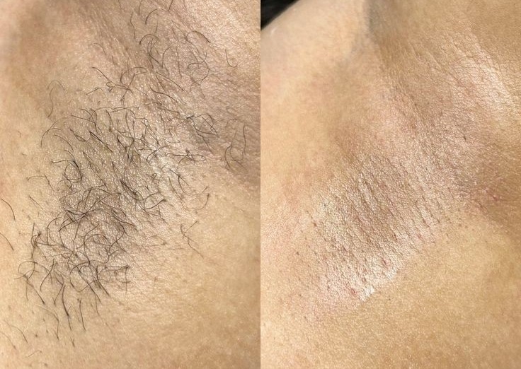 Haarentfernung /Epilat cu ceara 