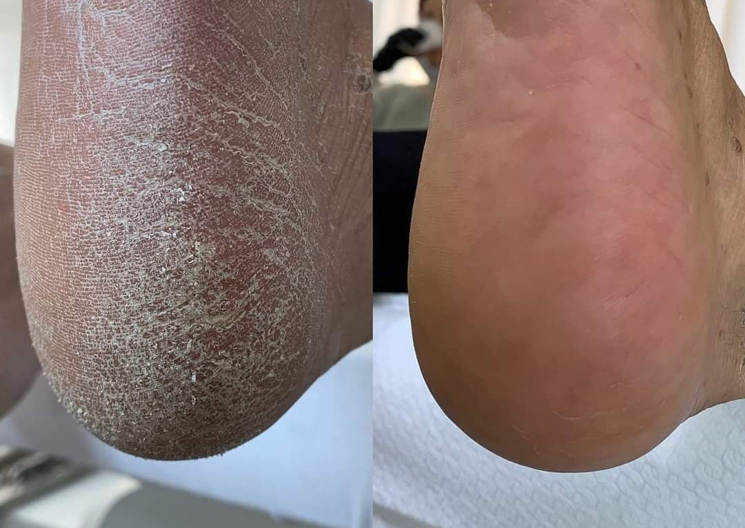 Fußpflege Profesional/Curățarea talpilor