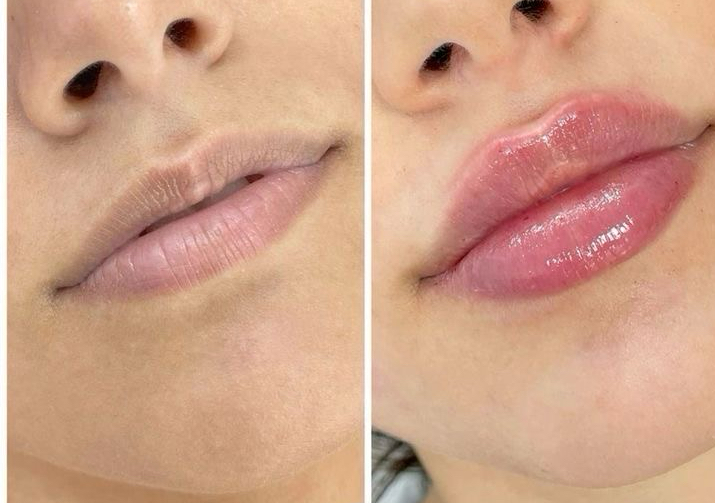 Lips filler (hyaluropen)