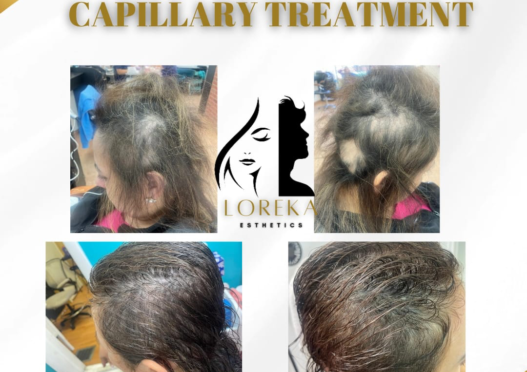 PRP capillar / PRP in Hair 