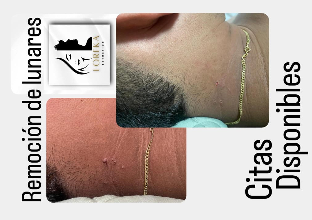 Cauterizacion de verrugas / Remove skin tags