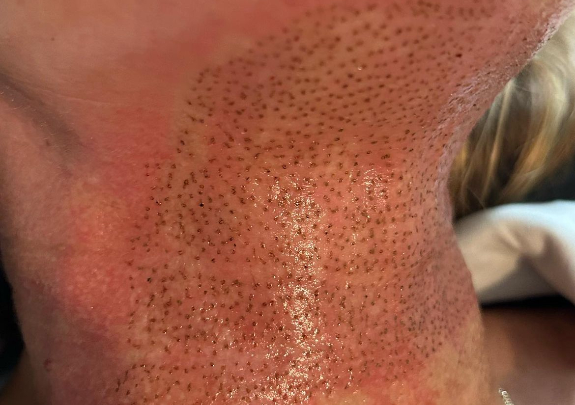 Plasma Pen Fibroblasting - Neck 