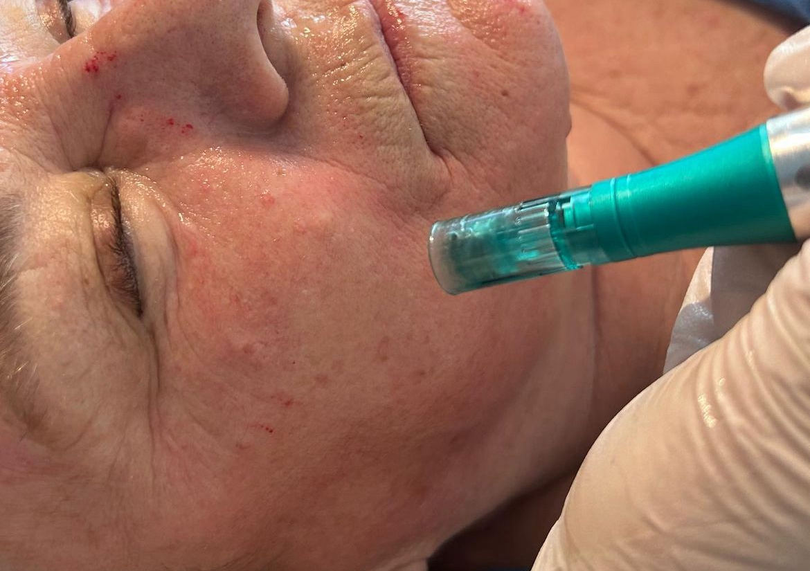 Microneedling facial