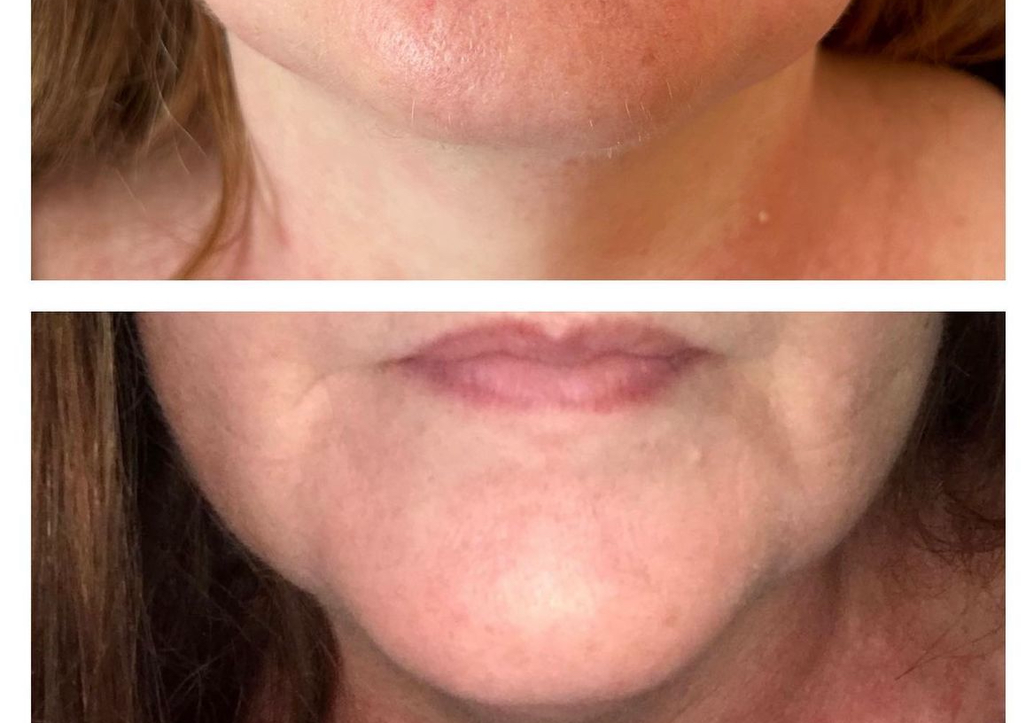 Lemon bottle chin and jowls 