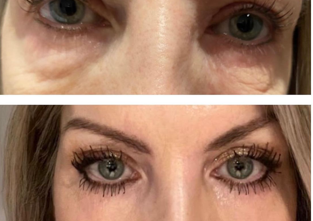 Plasma Pen Fibroblasting - Lower Eye