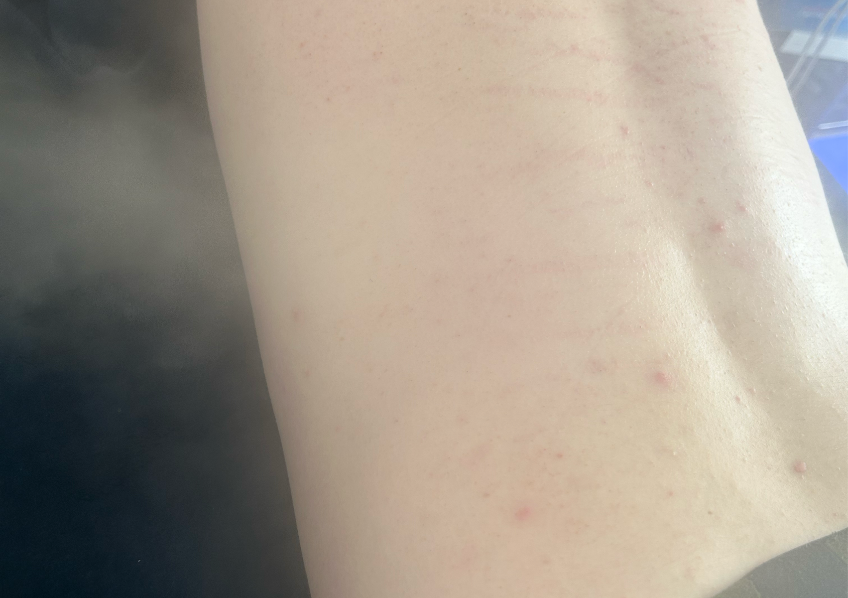 Back treatment - Deep cleasne 