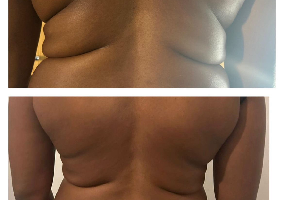 Lemon Bottle Fat Dissolving Large area