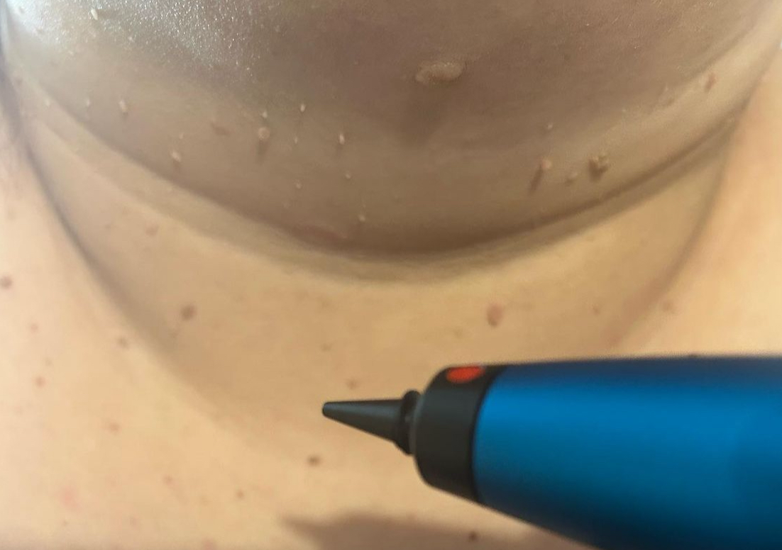 Cryopen