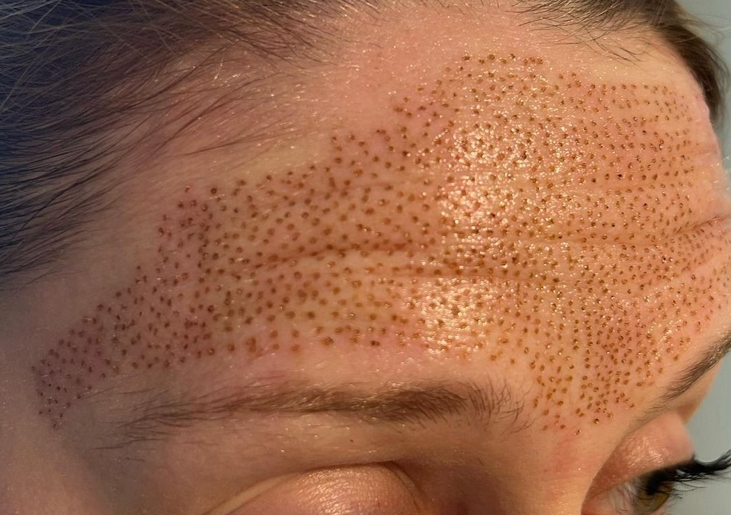 Plasma Pen Fibroblasting - Forehead