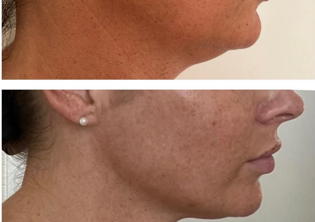 Lemon bottle fat dissolving chin 