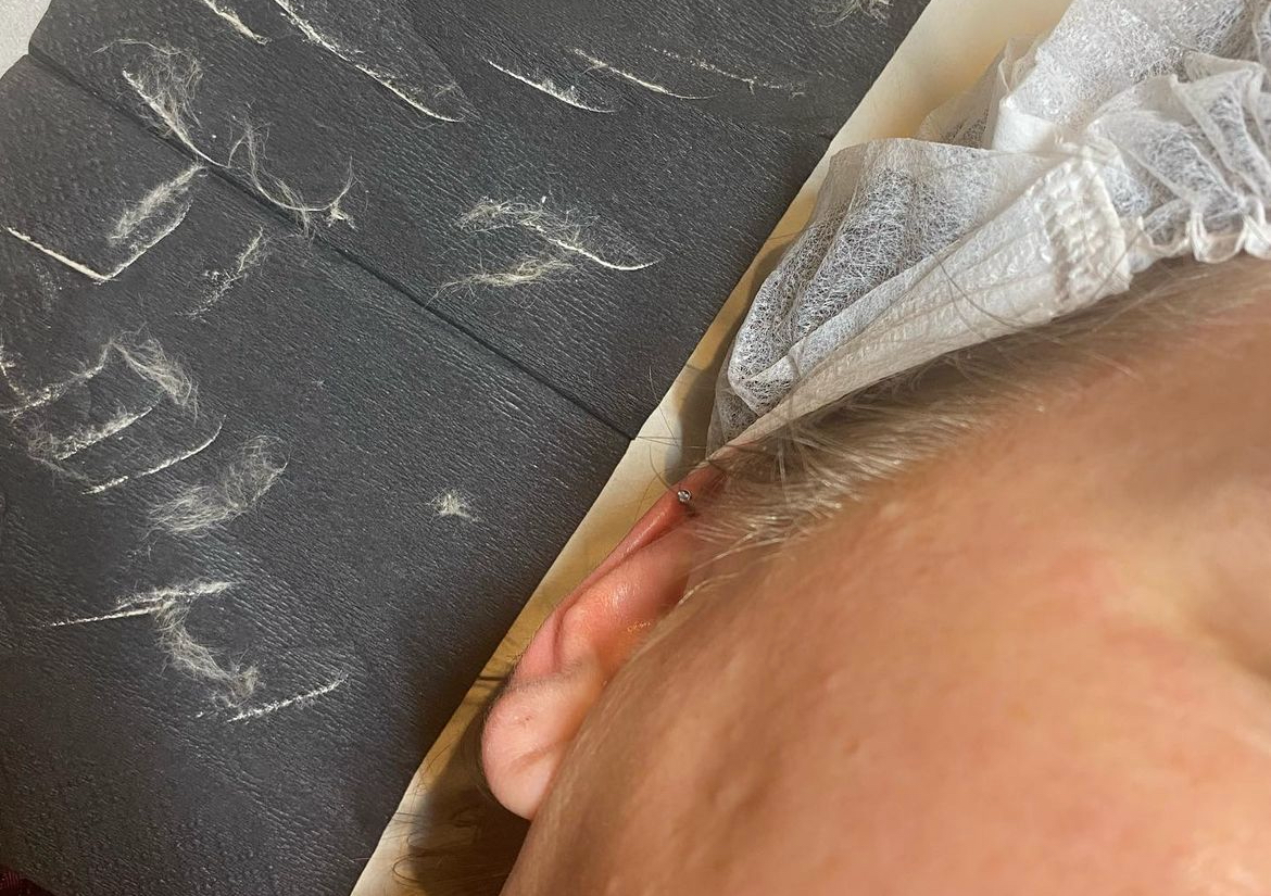 Dermaplaning facial