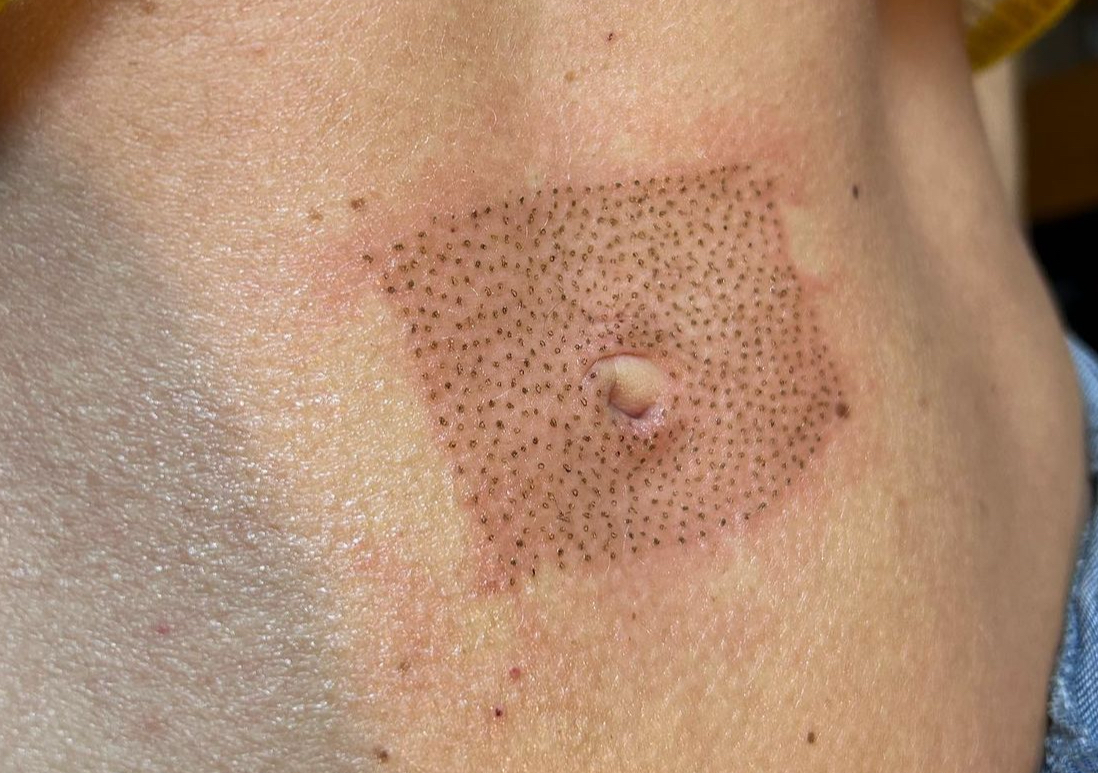Plasma Pen Fibroblasting - Belly Button