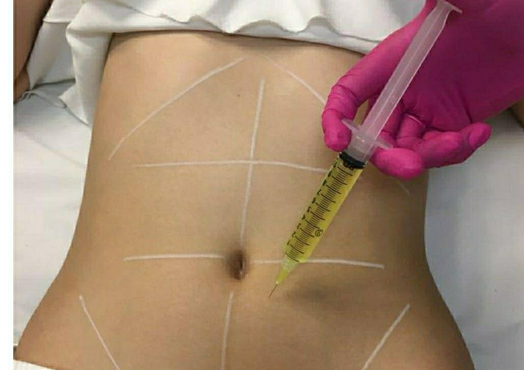 Mesoterapia corporal