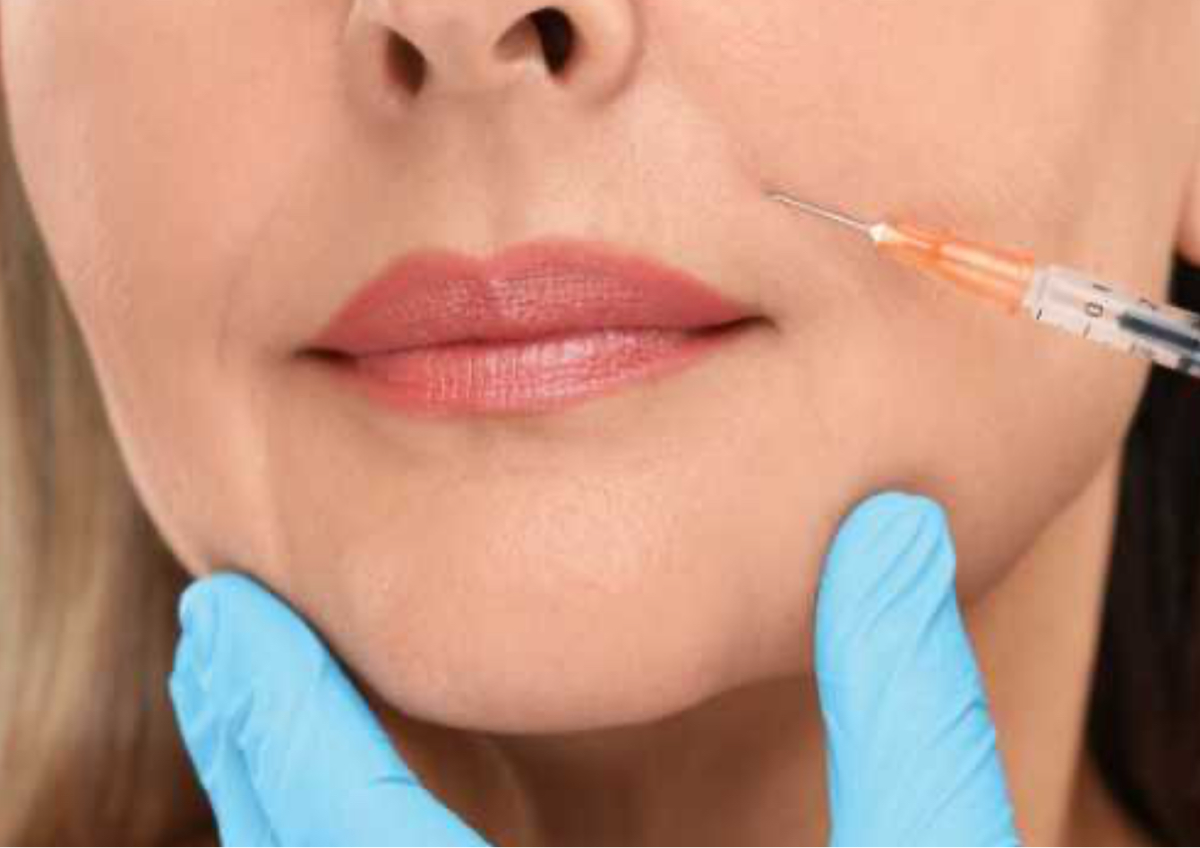 Correccion de surcos nasogenianos