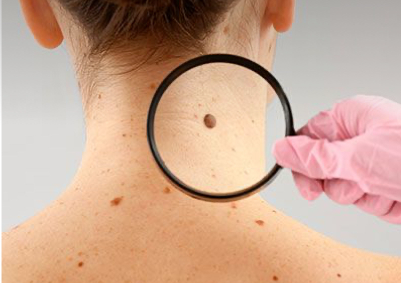 Remocion de verrugas