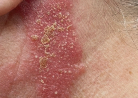 Skin Test for chosen Colour service. Skin Test Required 48 hours before every new Colour Service or chemical service. 