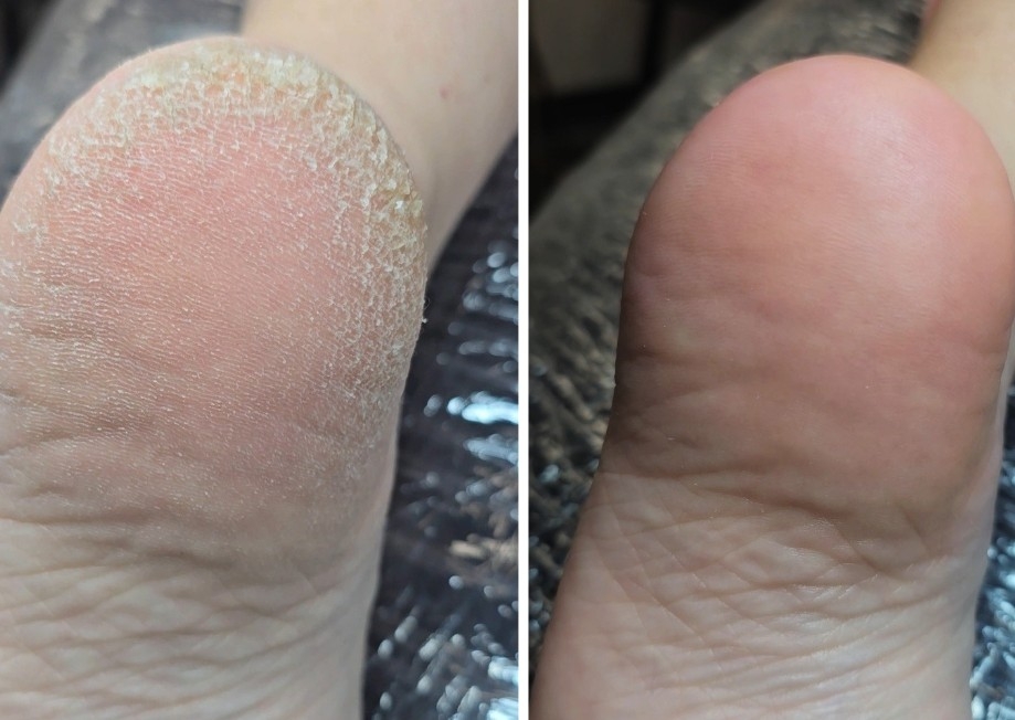 Pododisc Pedicure