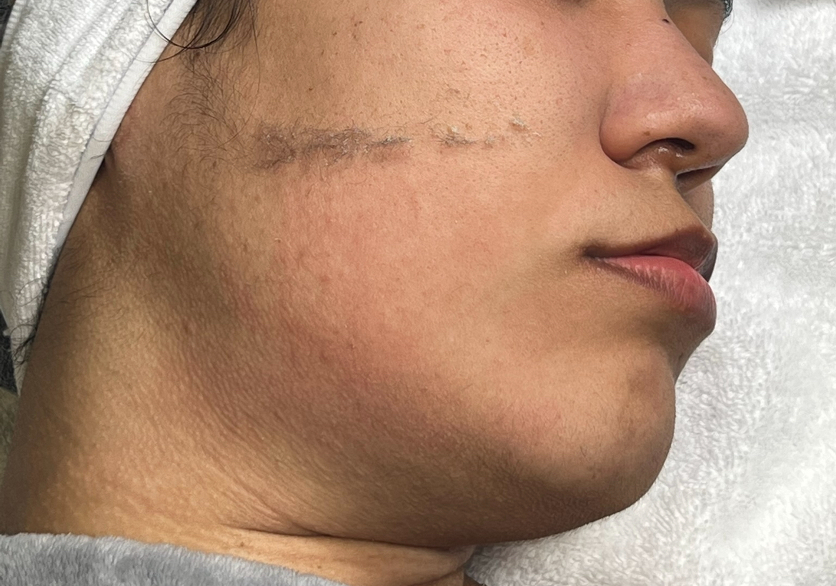 Dermaplaning /Tratamiendo de Dermaplaning