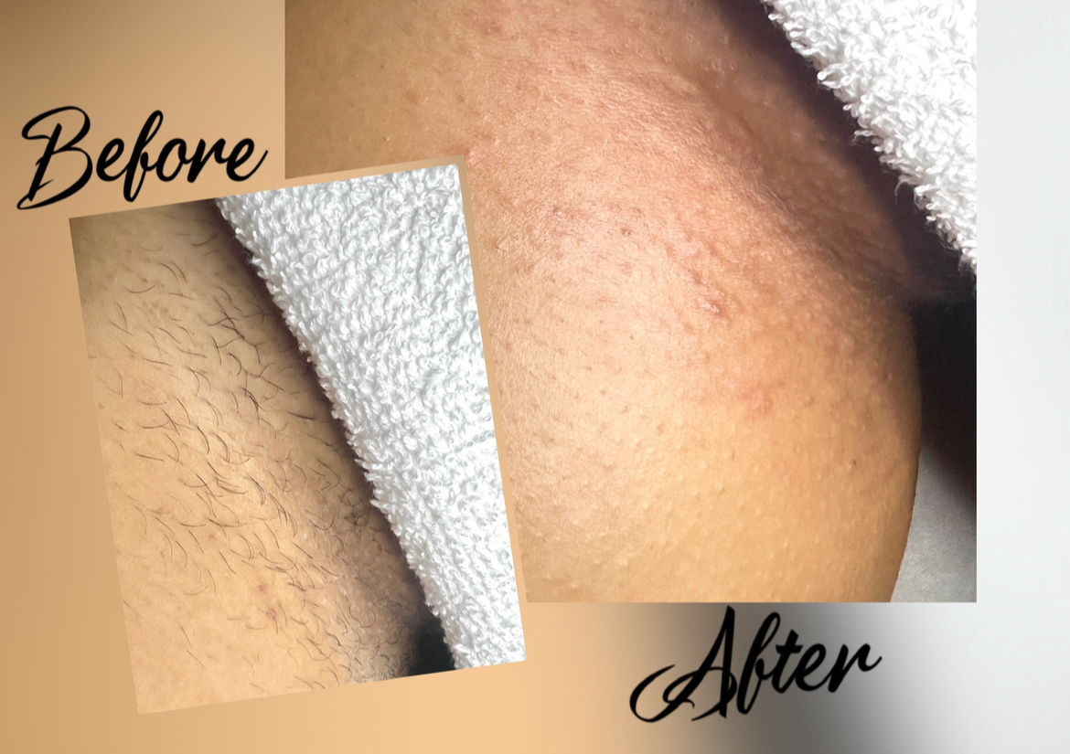 Bikini Wax/Linea de Bikini