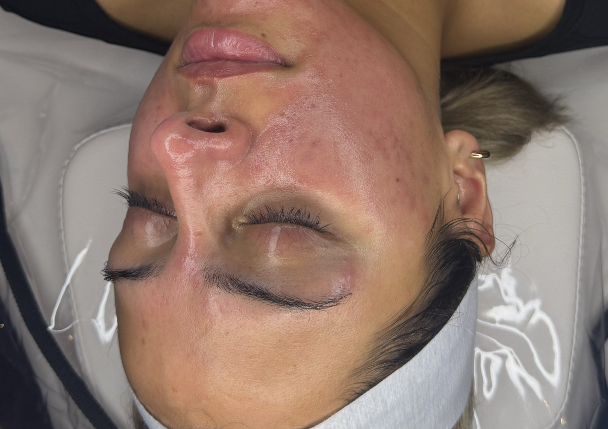 Microneedling with Salmon DNA 