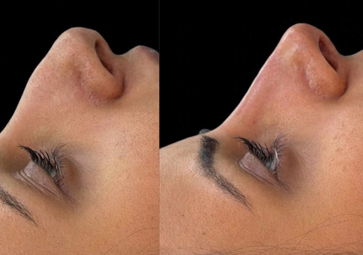 Non surgical rhinoplasty