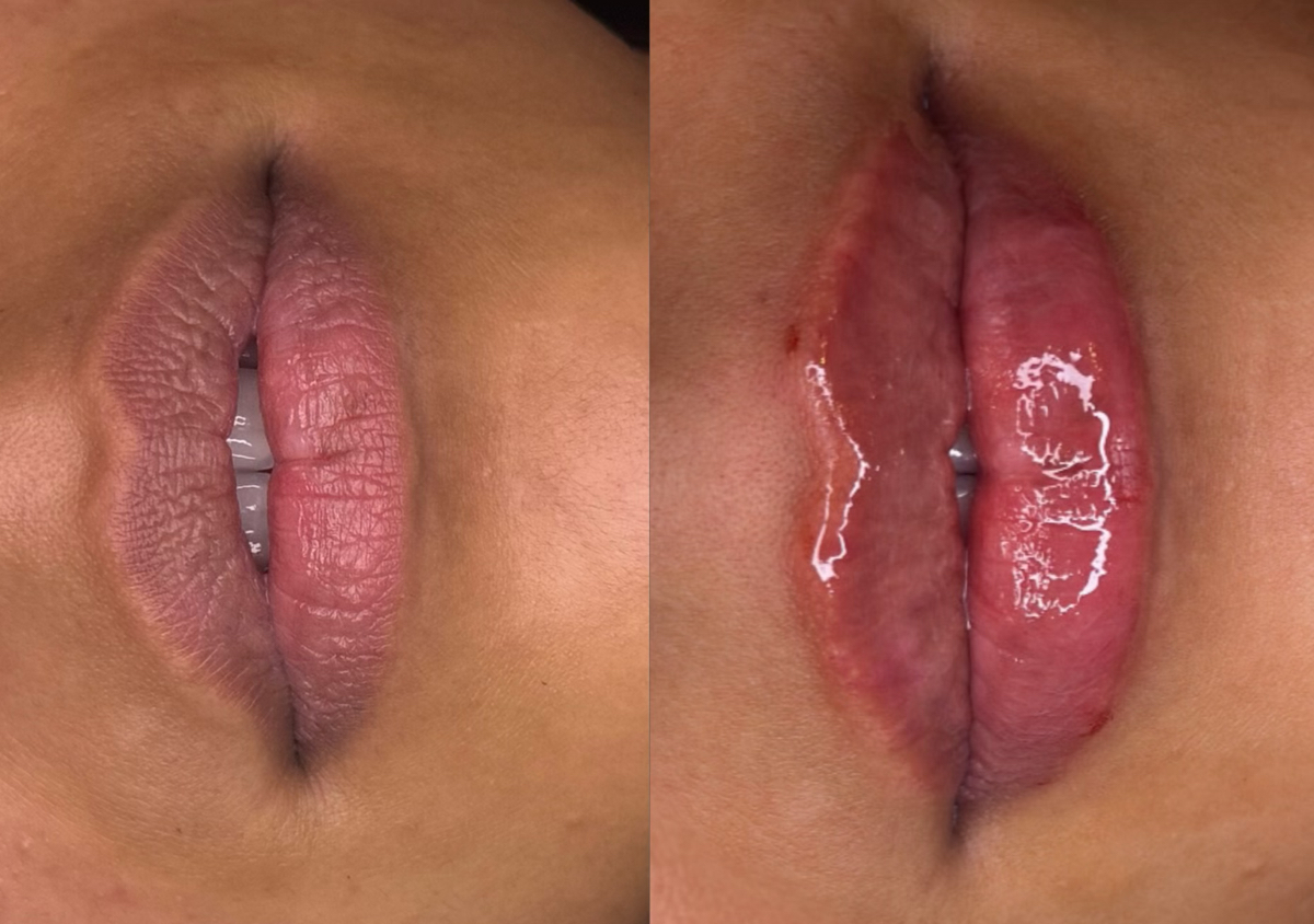 0.7 ml lip filler 