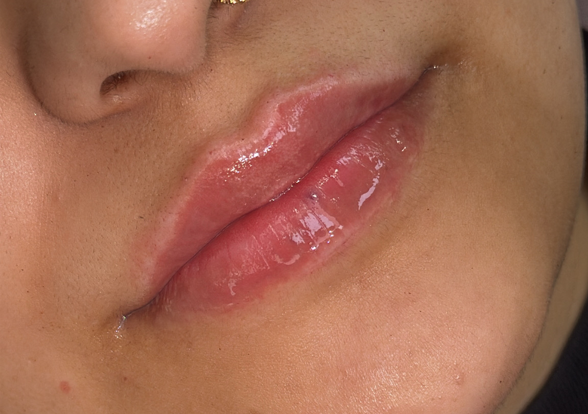 0.5 ml lip filler 