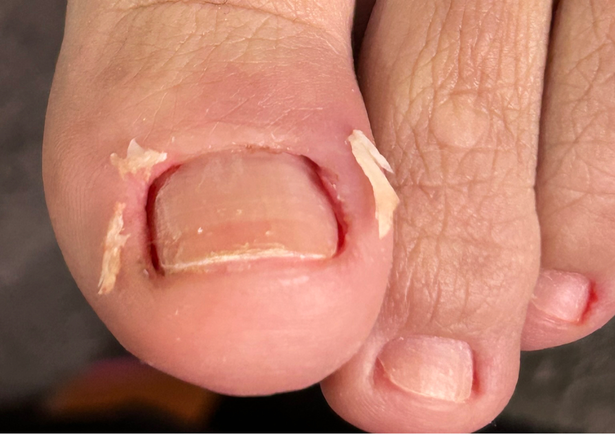 Desncravar 1 unha do pé 