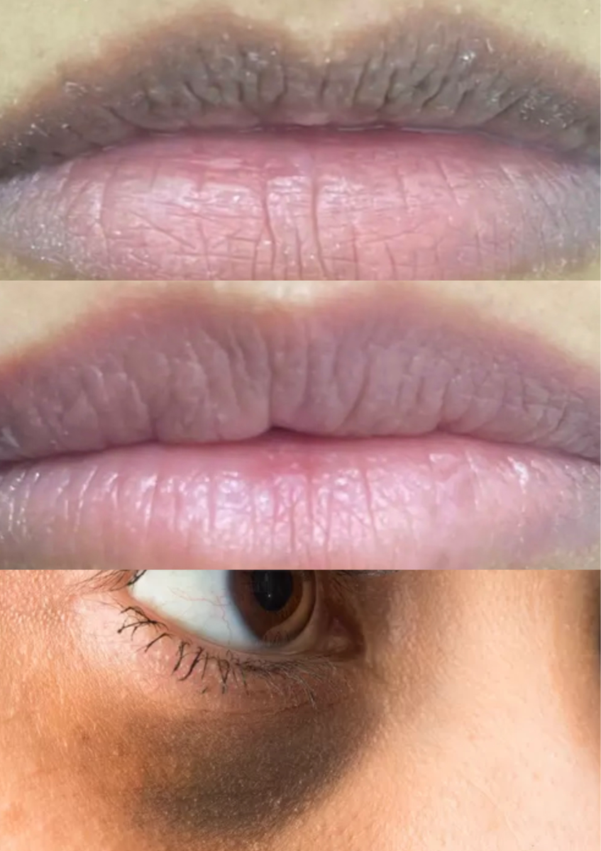 Lip lightening or Under Eye Lightenning
