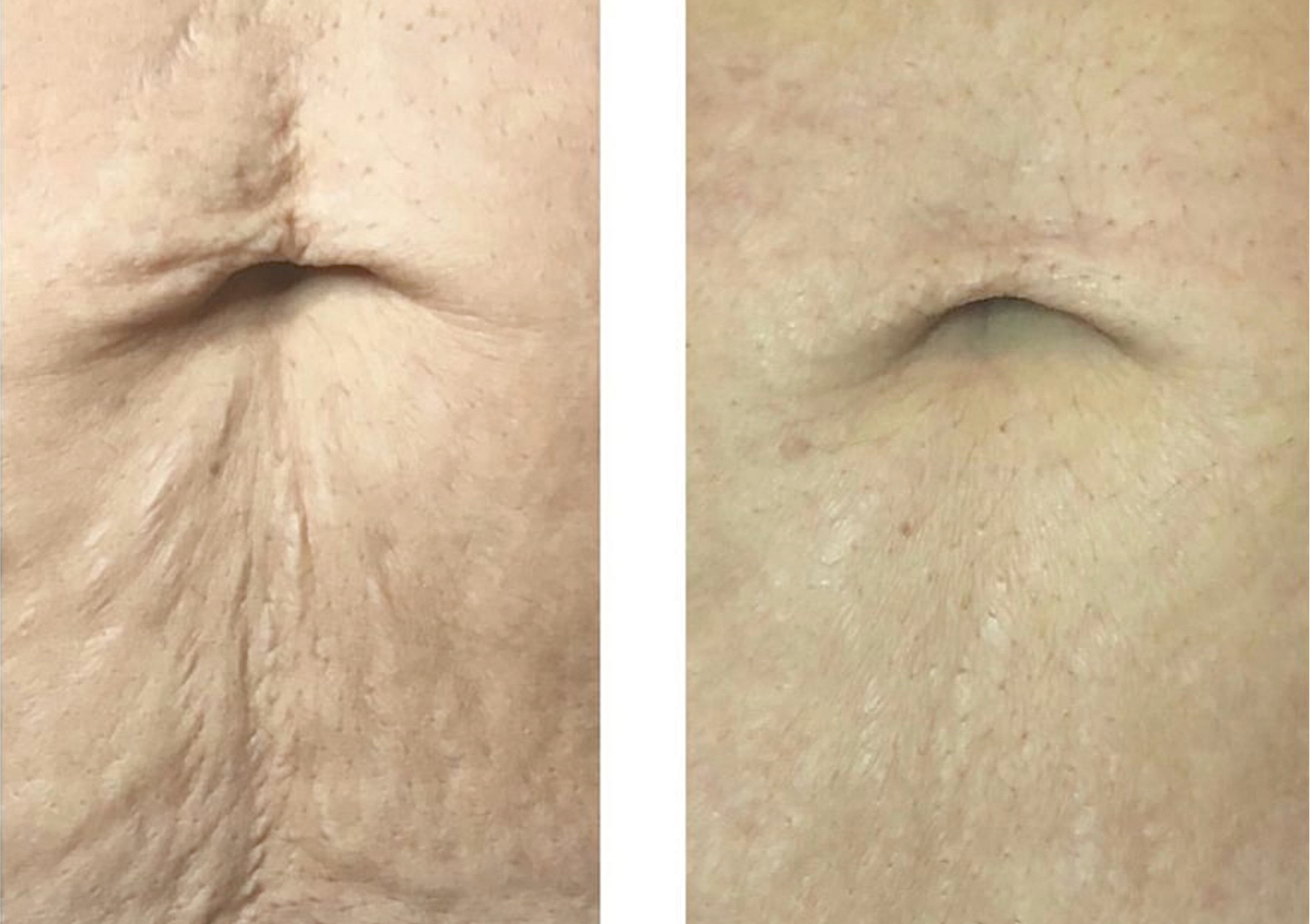 Revisión de Estrías / Inkless Stretch Mark Revision