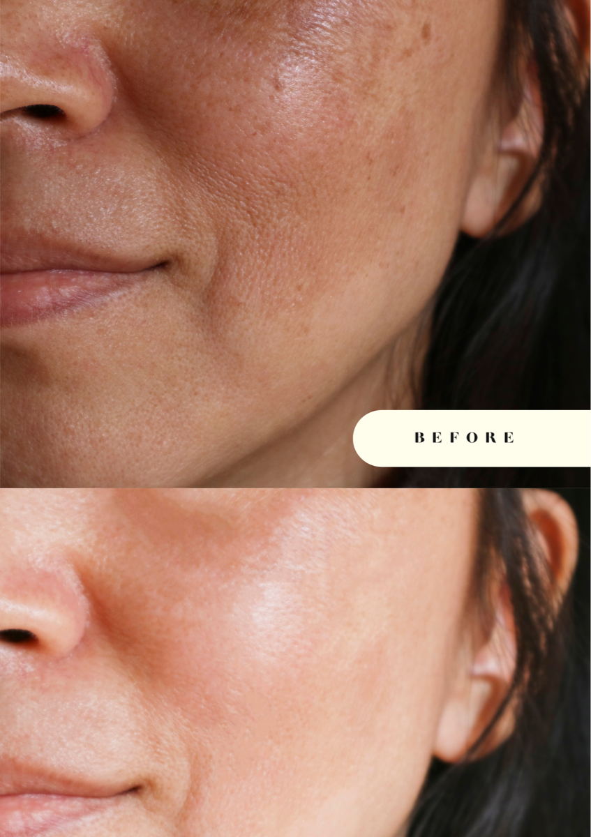 Melasma & Manchas