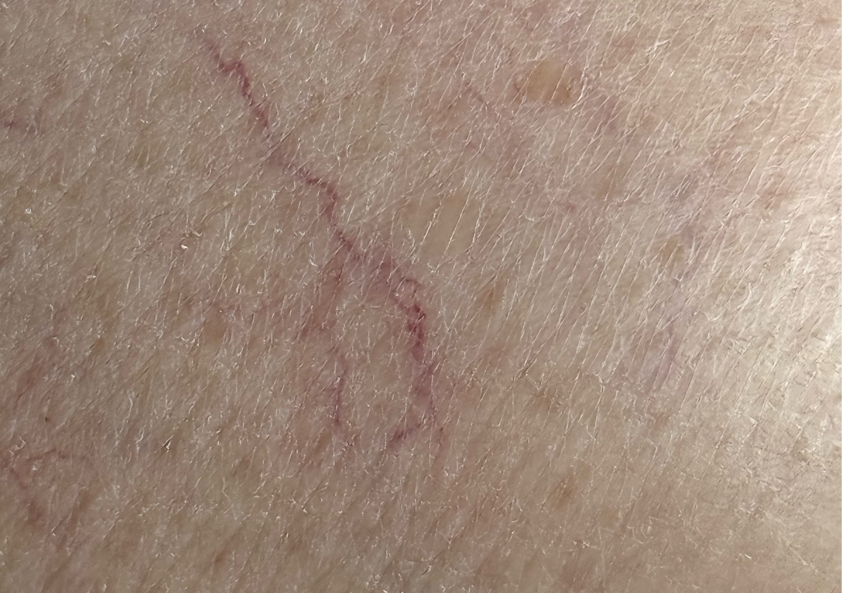 Remoción Telangestasias “Spider veins” rostro 