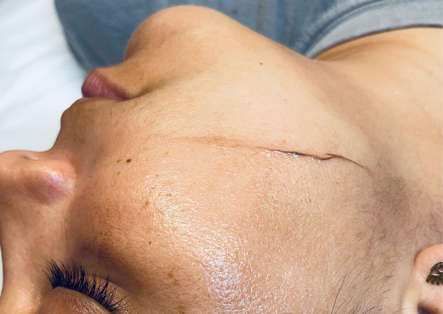 Facial Dermaplaning