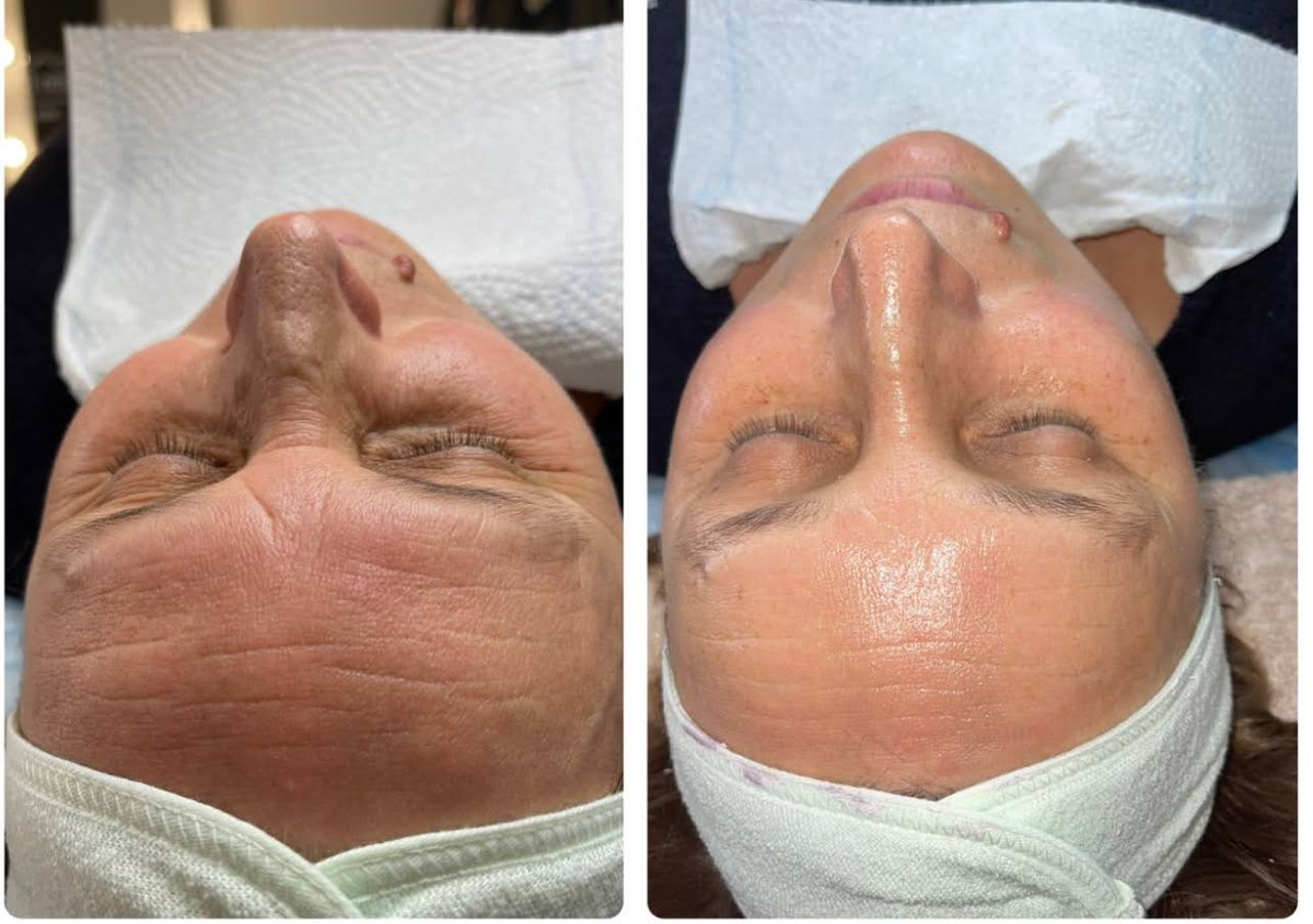 Procedure “Bright” +rf (cosmetic) or microcarrent