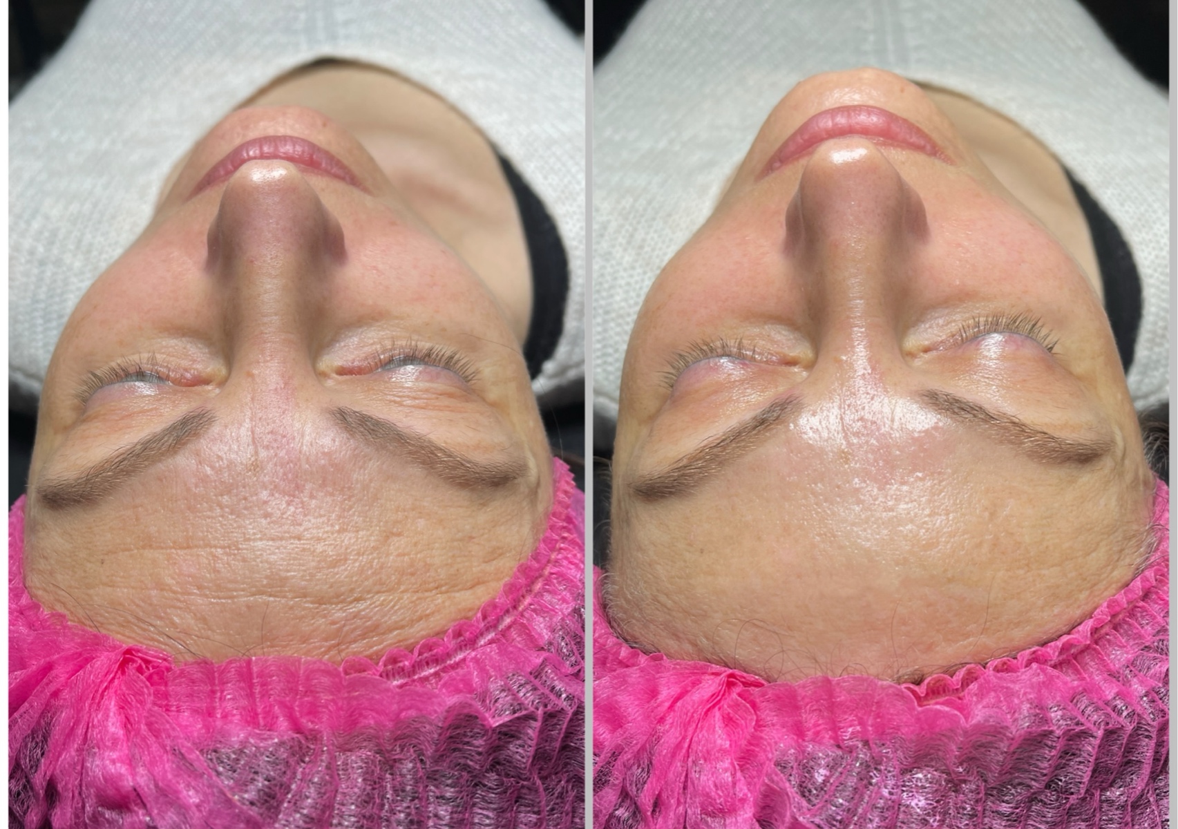 RF (cosmetic) new generation 