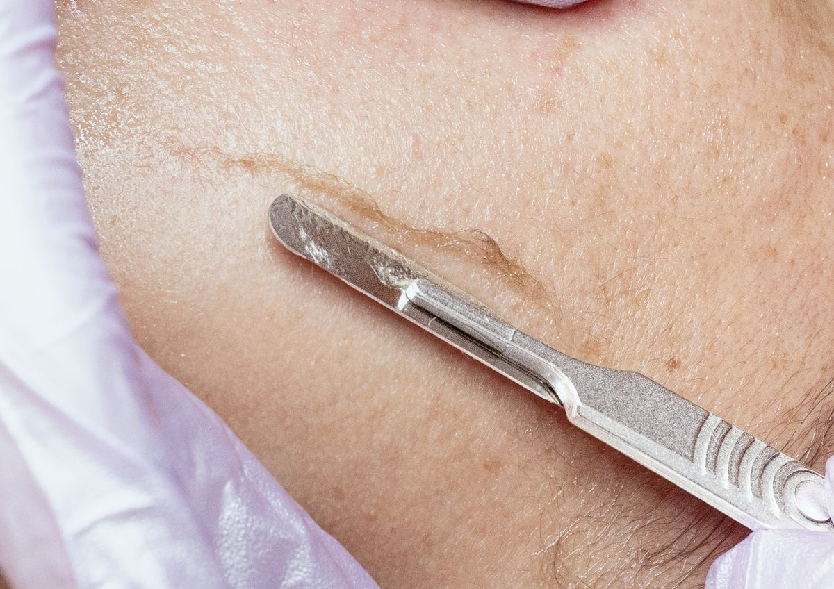 Deep Cleanse with Dermaplane